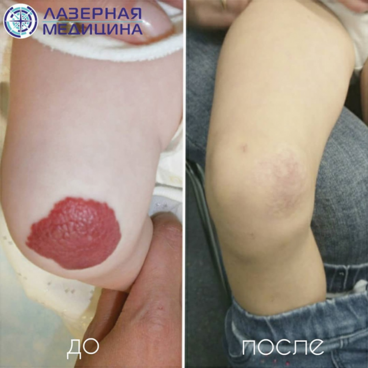Удаление новообразований калининград